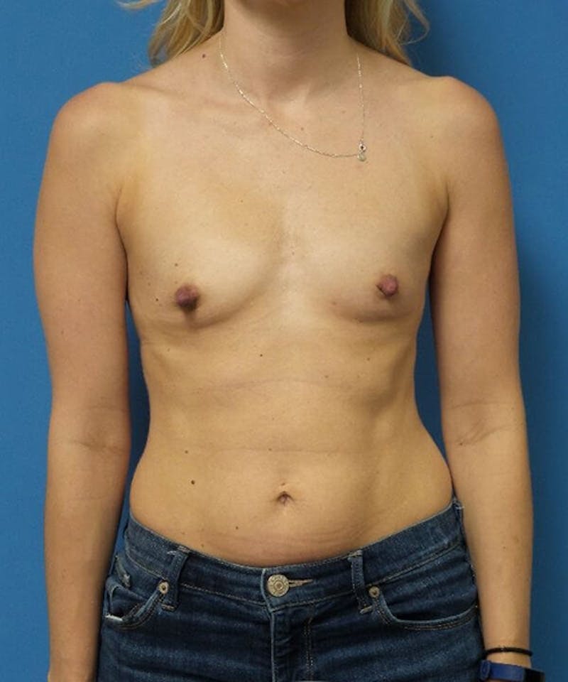 Breast Augmentation Before & After Gallery - Patient 930070 - Image 1