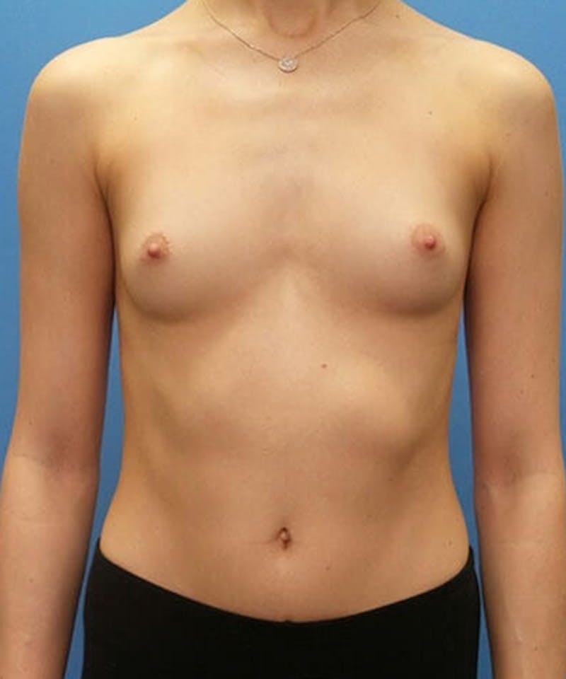 Breast Augmentation Before & After Gallery - Patient 381763 - Image 1