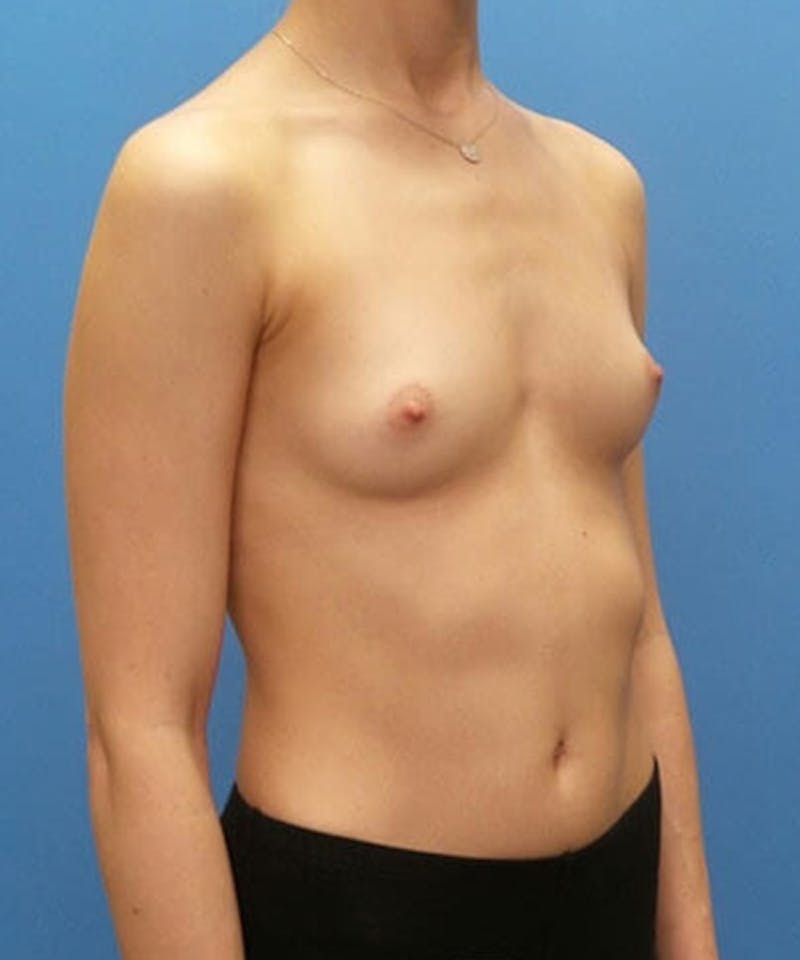 Breast Lift Before & After Gallery - Patient 164673 - Image 3
