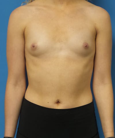 Breast Lift Before & After Gallery - Patient 417540 - Image 1