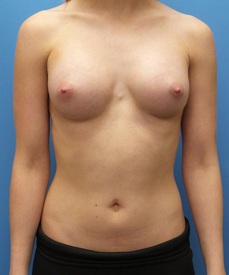 Breast Augmentation Before & After Gallery - Patient 169792 - Image 2