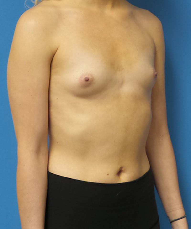 Breast Lift Before & After Gallery - Patient 417540 - Image 3