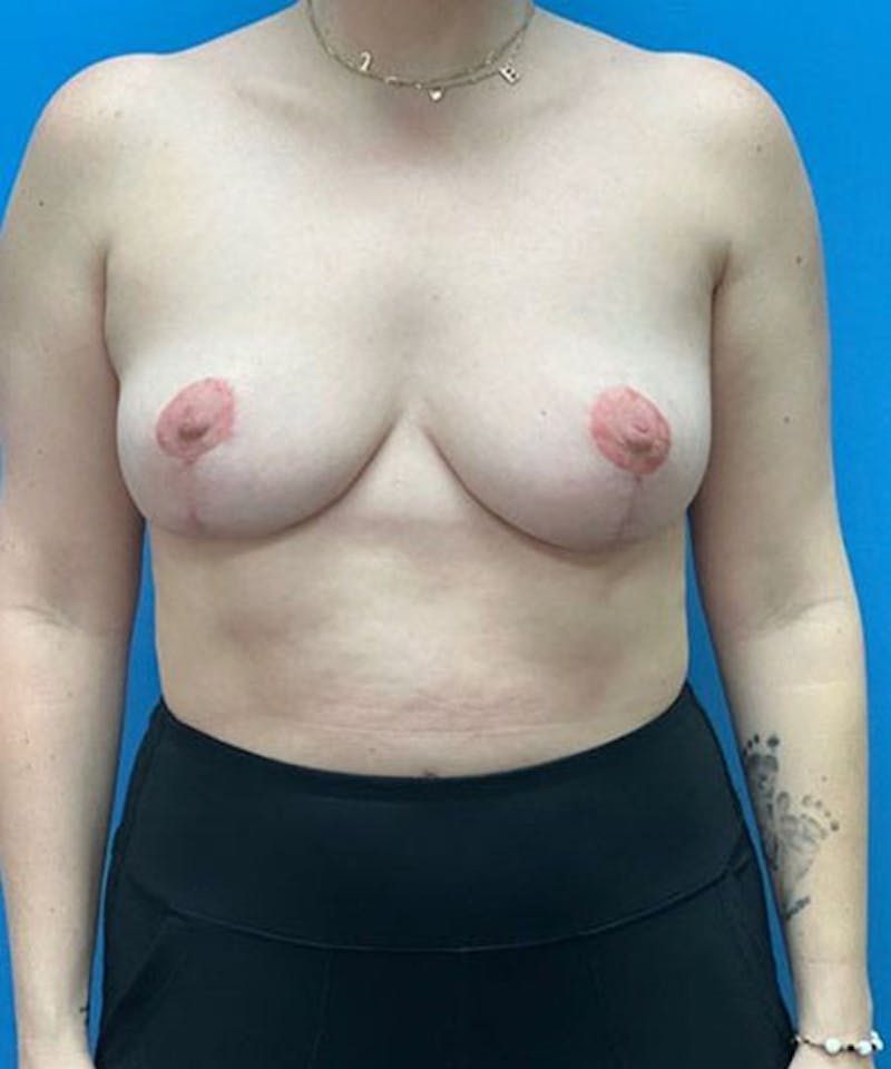 Breast Lift Before & After Gallery - Patient 169504 - Image 2
