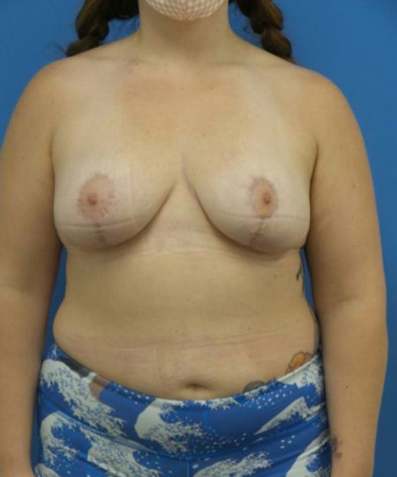 Breast Lift Before & After Gallery - Patient 253046 - Image 2