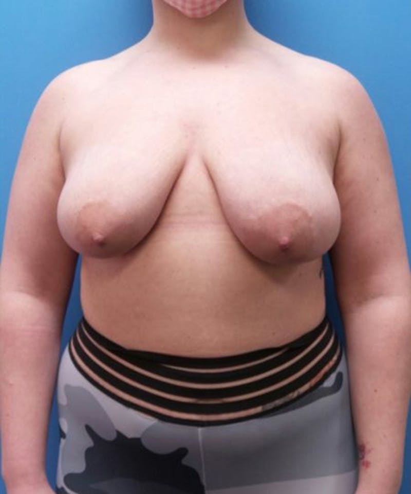 Breast Lift Before & After Gallery - Patient 253046 - Image 1