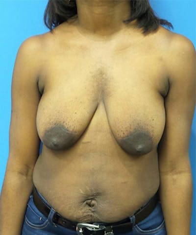 Breast Lift Before & After Gallery - Patient 183168 - Image 1