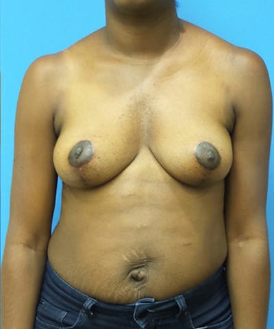 Breast Lift Before & After Gallery - Patient 183168 - Image 2
