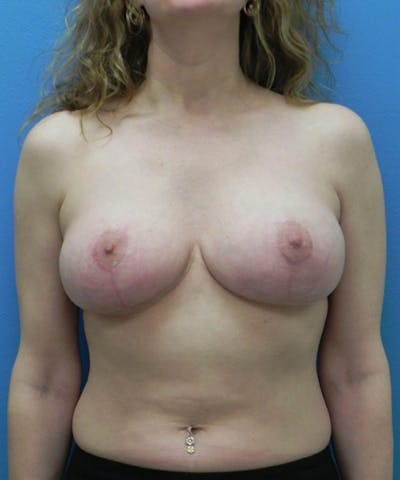 Breast Lift Before & After Gallery - Patient 778728 - Image 2