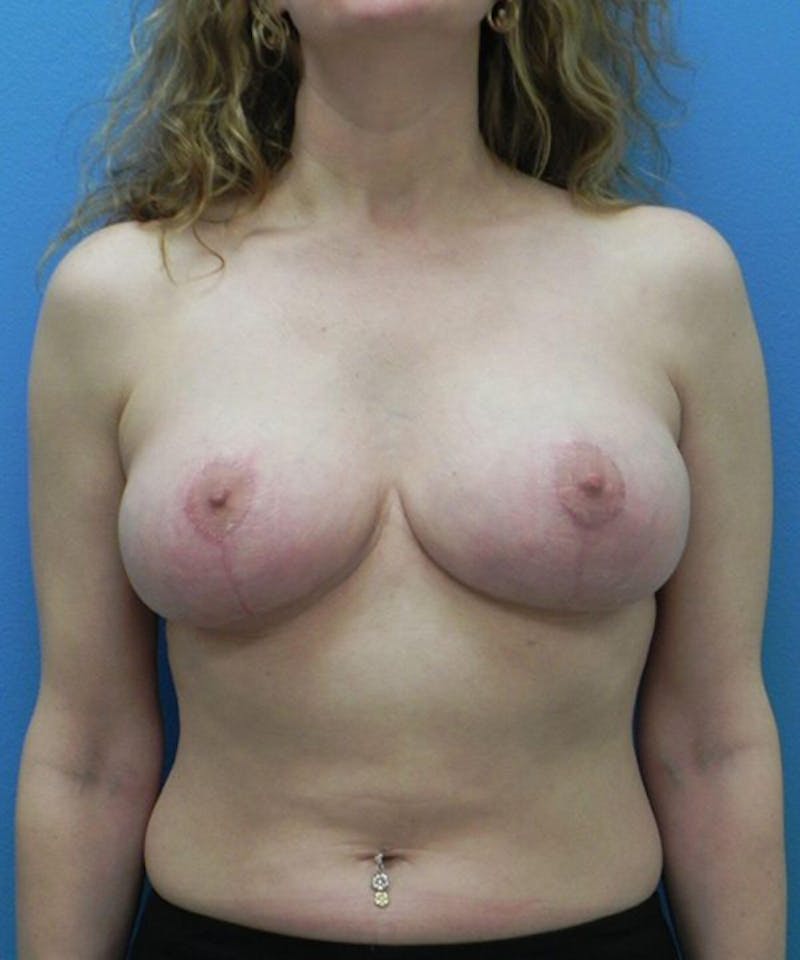 Breast Lift Before & After Gallery - Patient 778728 - Image 2