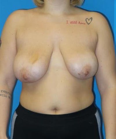 Breast Lift Before & After Gallery - Patient 323685 - Image 1