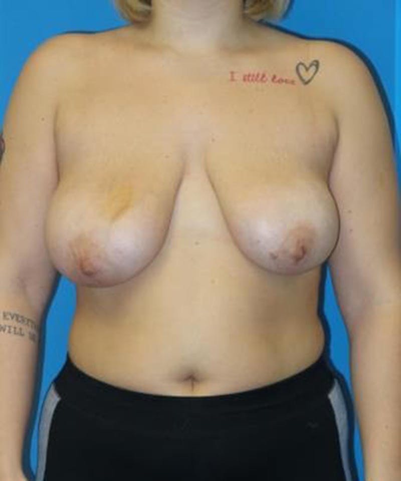 Breast Lift Before & After Gallery - Patient 323685 - Image 1
