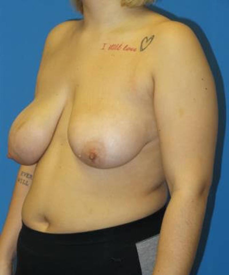 Breast Lift Before & After Gallery - Patient 323685 - Image 3