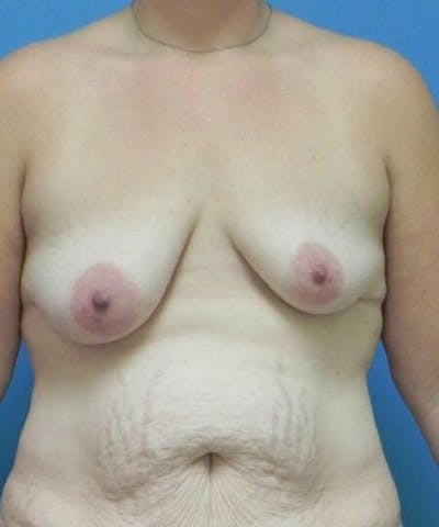 Breast Lift Before & After Gallery - Patient 239715 - Image 1