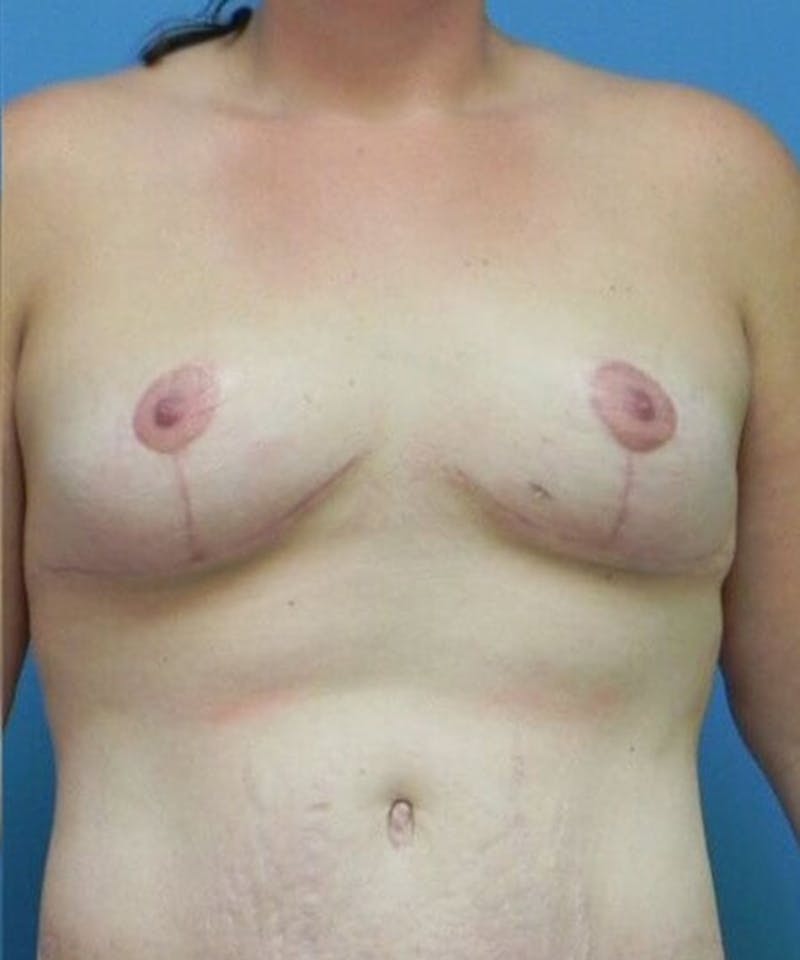 Breast Lift Before & After Gallery - Patient 239715 - Image 2
