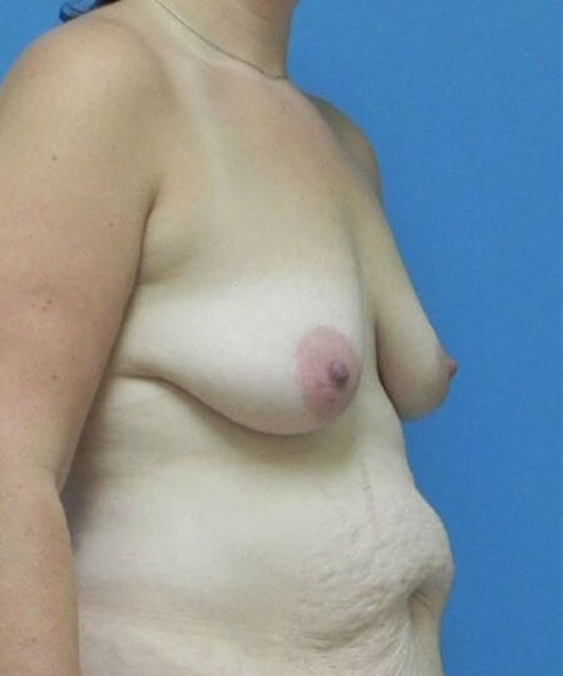 Breast Lift Before & After Gallery - Patient 239715 - Image 3