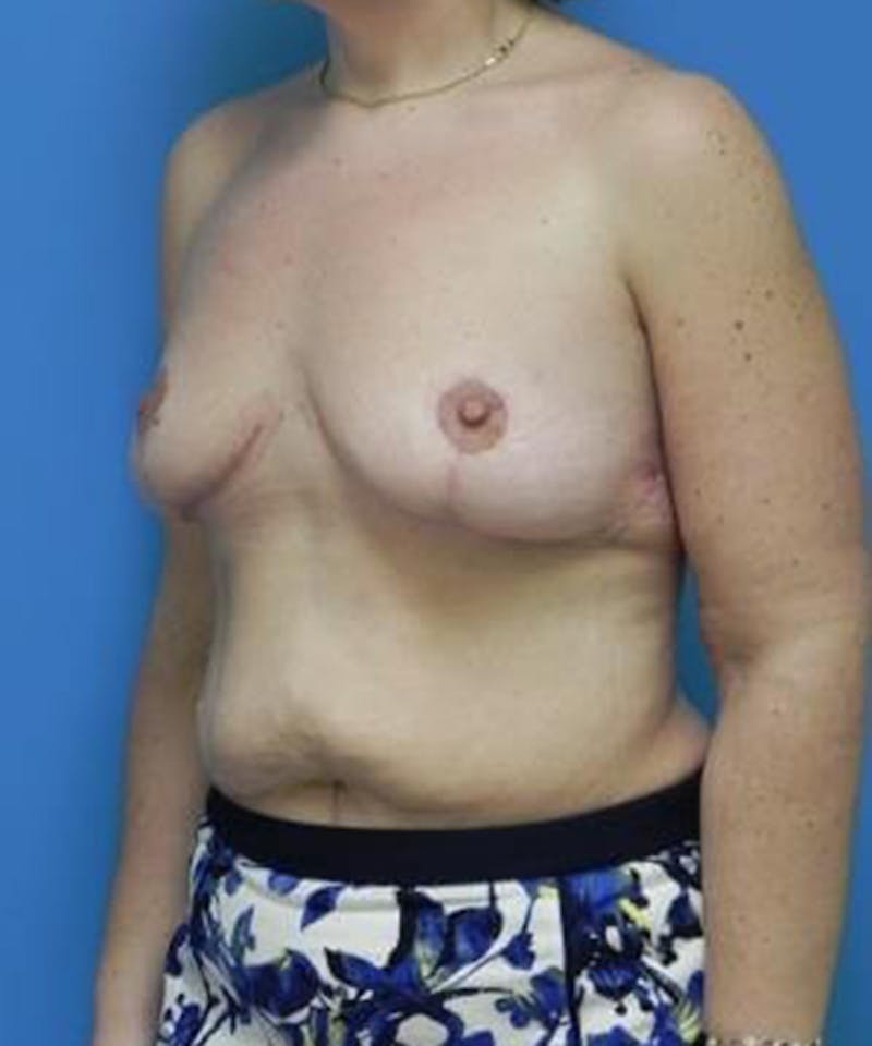 Breast Lift Before & After Gallery - Patient 229076 - Image 4