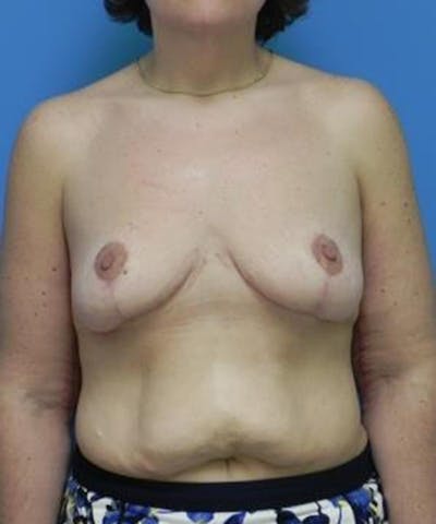 Breast Lift Before & After Gallery - Patient 229076 - Image 2