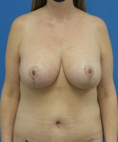 Breast Lift Before & After Gallery - Patient 109945 - Image 2
