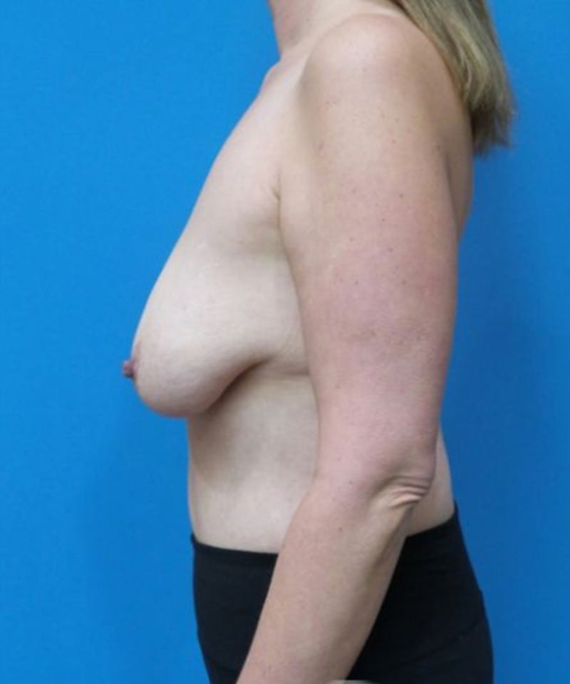 Breast Augmentation Before & After Gallery - Patient 286442 - Image 3
