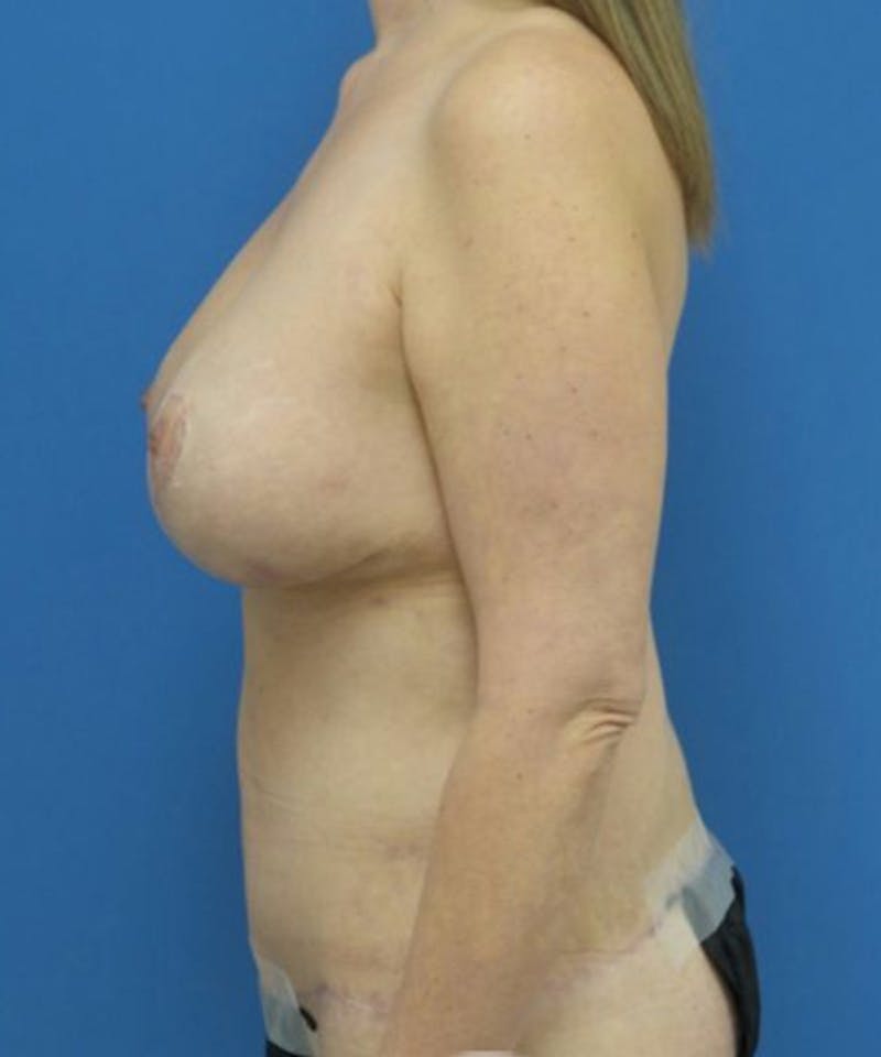 Breast Lift Before & After Gallery - Patient 109945 - Image 4