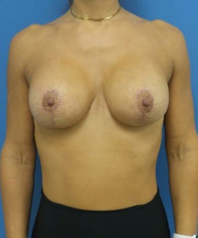 Breast Lift Before & After Gallery - Patient 411101 - Image 2