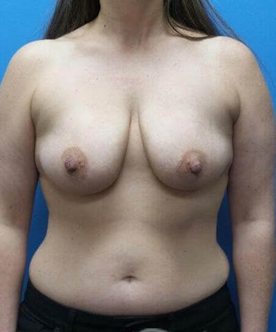 Breast Augmentation Before & After Gallery - Patient 281113 - Image 1