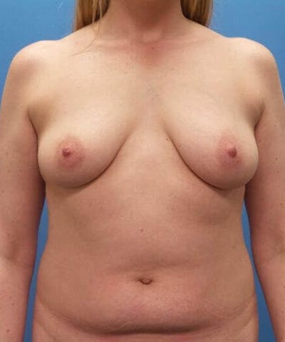 Breast Augmentation Before & After Gallery - Patient 383249 - Image 1