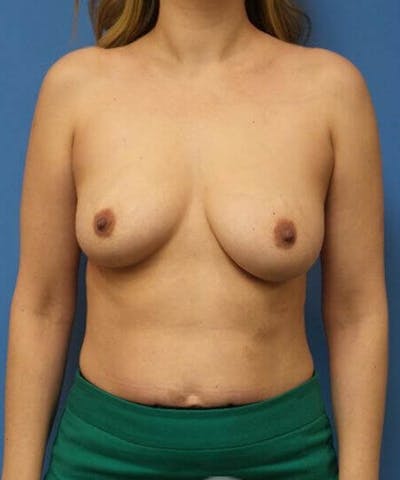 Breast Lift Before & After Gallery - Patient 284034 - Image 1