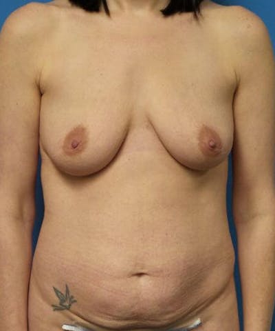 Breast Lift Before & After Gallery - Patient 375492 - Image 1