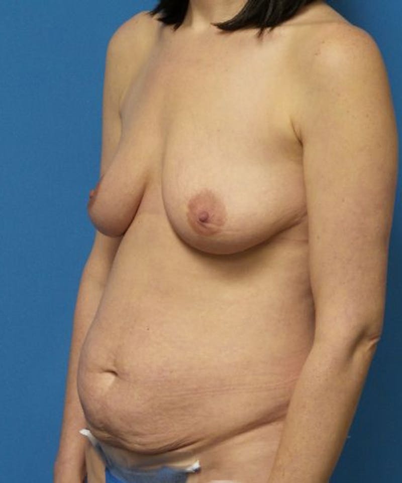 Breast Lift Before & After Gallery - Patient 375492 - Image 3