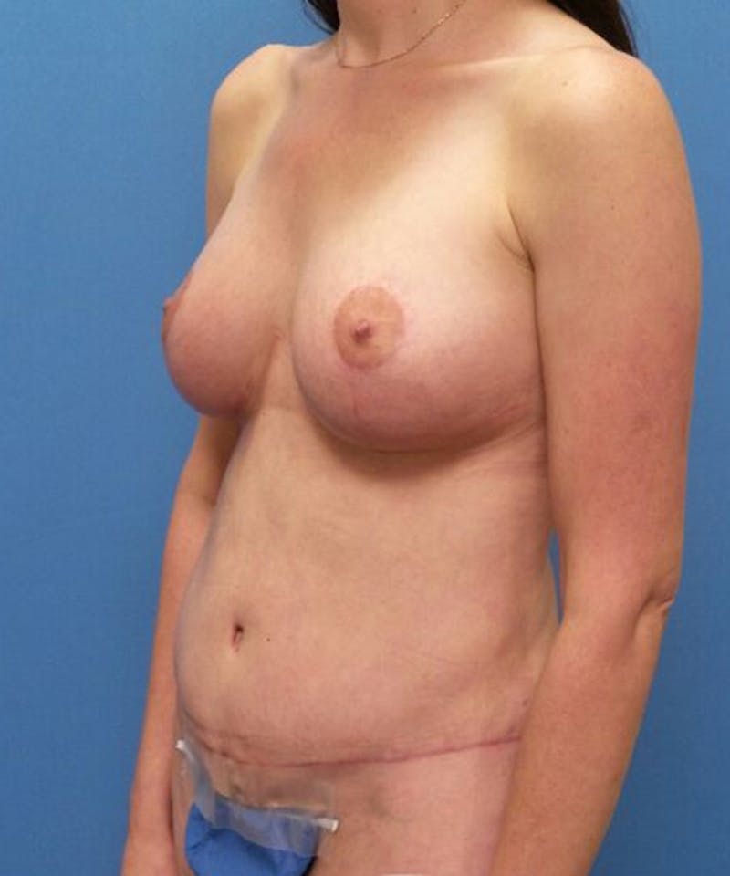 Breast Lift Before & After Gallery - Patient 375492 - Image 4