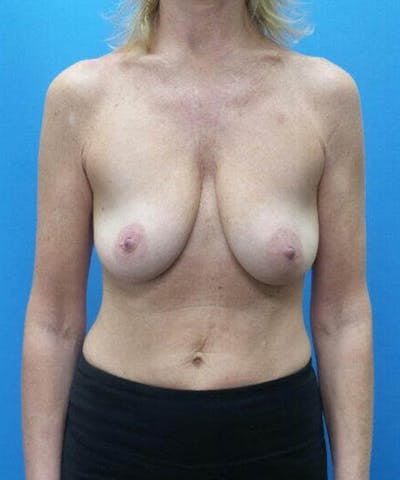 Breast Lift Before & After Gallery - Patient 173282 - Image 1