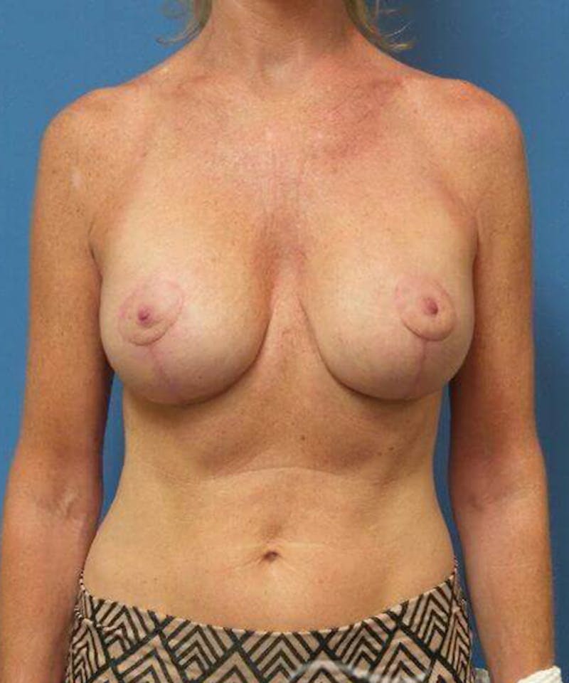 Breast Lift Before & After Gallery - Patient 173282 - Image 2