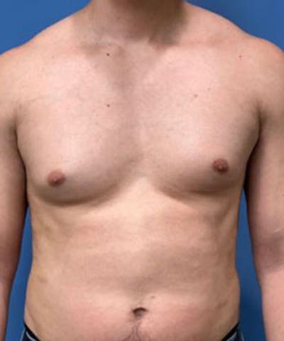 Gynecomastia Reduction Before & After Gallery - Patient 719288 - Image 1