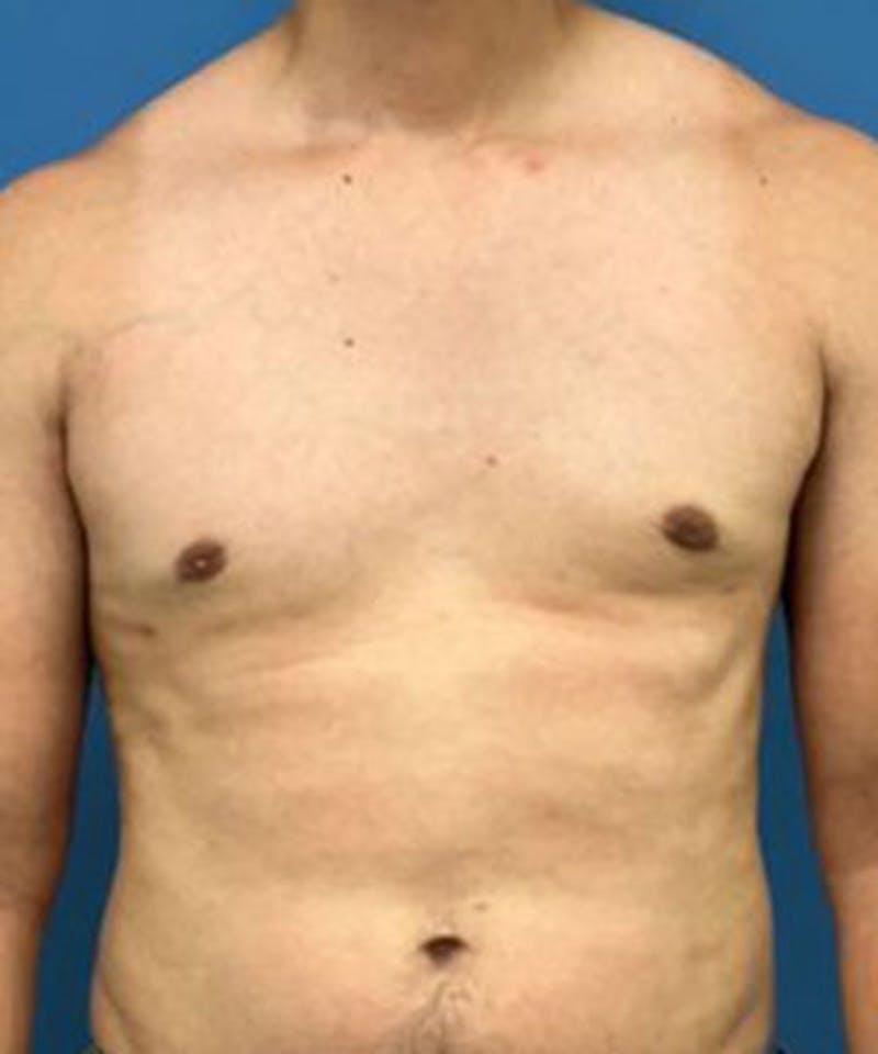 Gynecomastia Reduction Before & After Gallery - Patient 719288 - Image 2