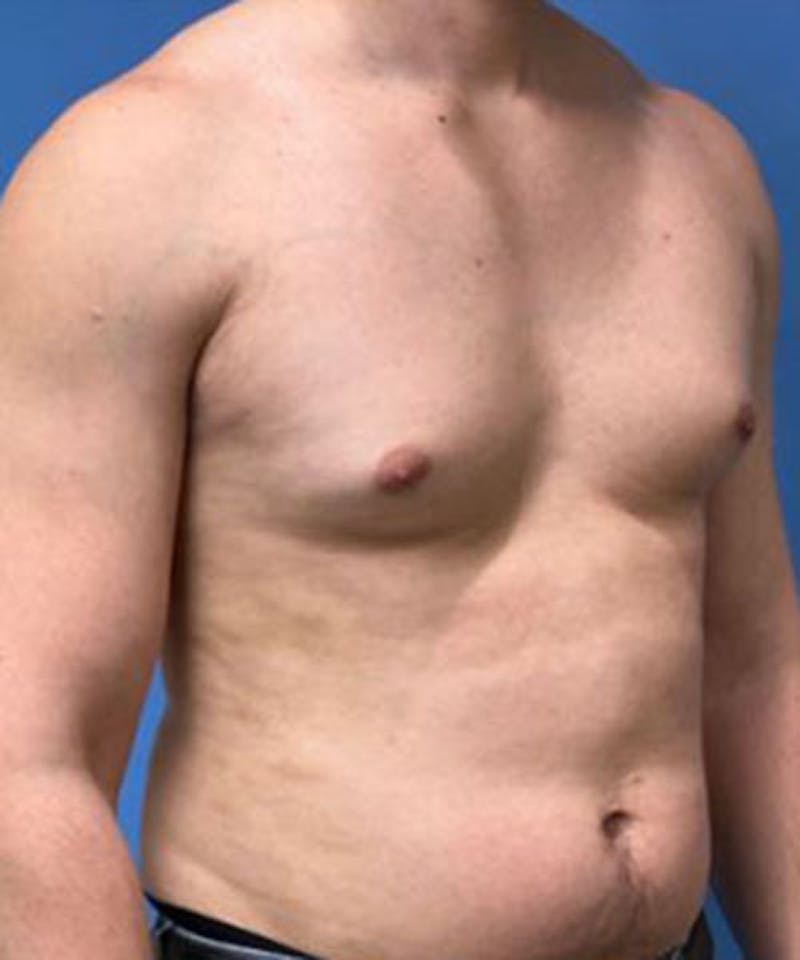 Gynecomastia Reduction Before & After Gallery - Patient 719288 - Image 3