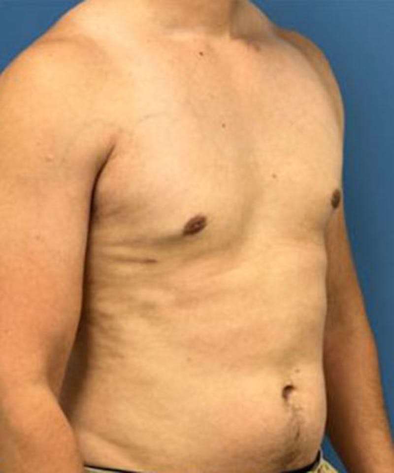 Gynecomastia Reduction Before & After Gallery - Patient 719288 - Image 4