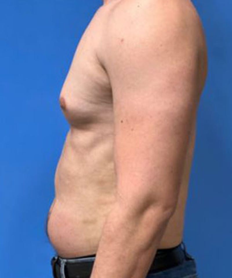 Gynecomastia Reduction Before & After Gallery - Patient 719288 - Image 5