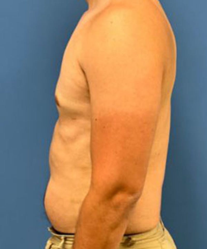 Gynecomastia Reduction Before & After Gallery - Patient 719288 - Image 6