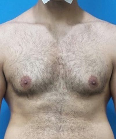Gynecomastia Reduction Before & After Gallery - Patient 188761 - Image 1