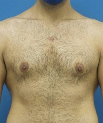 Gynecomastia Reduction Before & After Gallery - Patient 188761 - Image 2