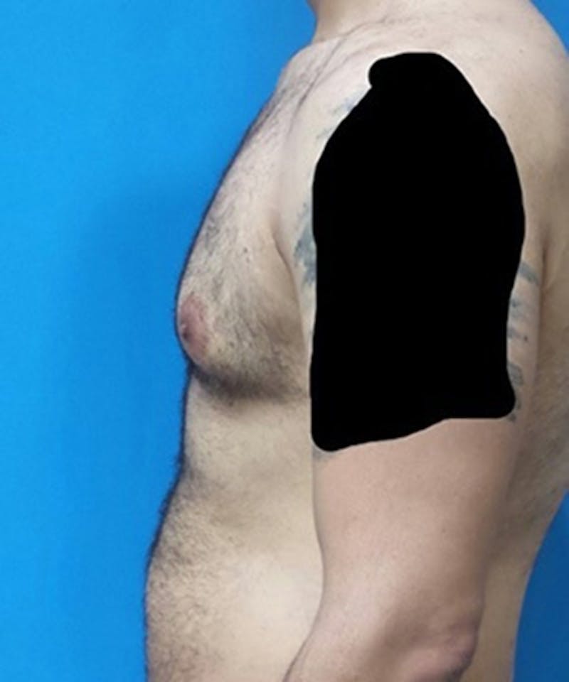 Gynecomastia Reduction Before & After Gallery - Patient 188761 - Image 3