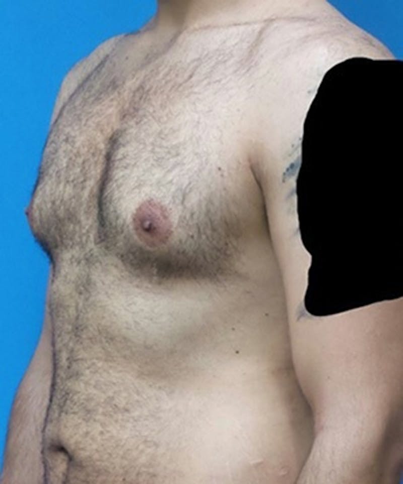 Gynecomastia Reduction Before & After Gallery - Patient 188761 - Image 5