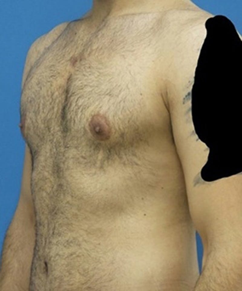 Gynecomastia Reduction Before & After Gallery - Patient 188761 - Image 6