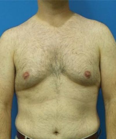 Gynecomastia Reduction Before & After Gallery - Patient 396865 - Image 1
