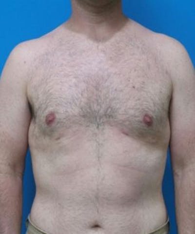 Gynecomastia Reduction Before & After Gallery - Patient 396865 - Image 2