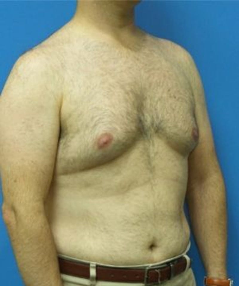 Gynecomastia Reduction Before & After Gallery - Patient 396865 - Image 3