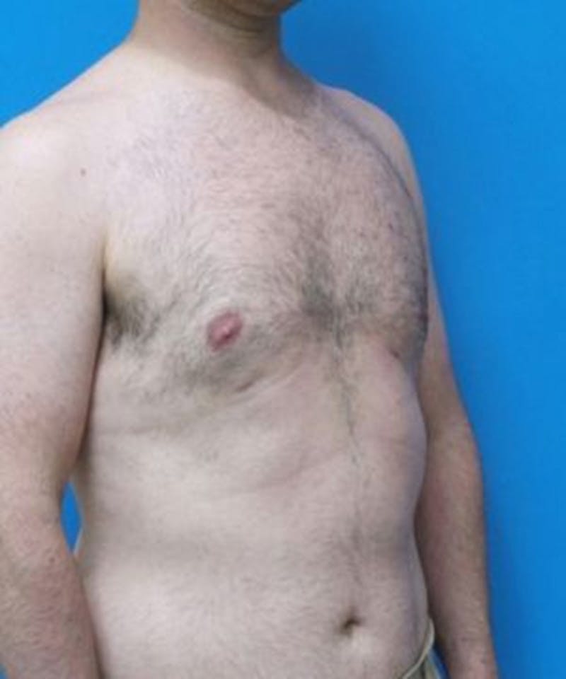 Gynecomastia Reduction Before & After Gallery - Patient 396865 - Image 4