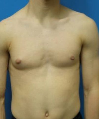 Gynecomastia Reduction Before & After Gallery - Patient 392759 - Image 1