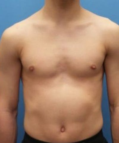 Gynecomastia Reduction Before & After Gallery - Patient 392759 - Image 2